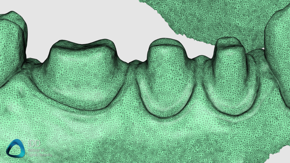 aoralscan 3 accuracy institute of digital dentistry (2)