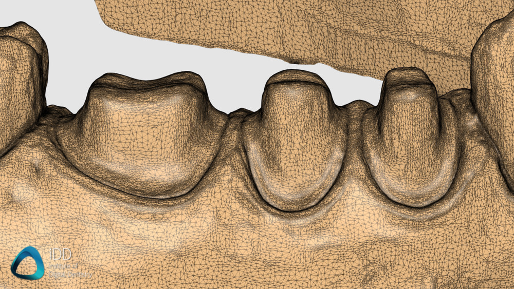 aoralscan 3 accuracy institute of digital dentistry (3)