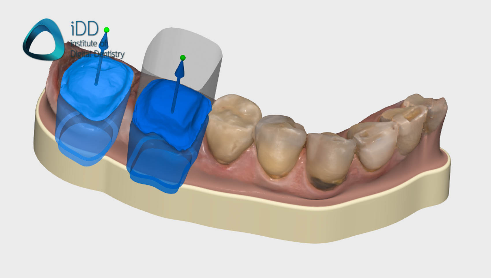 figure-10-exocad-design-medit