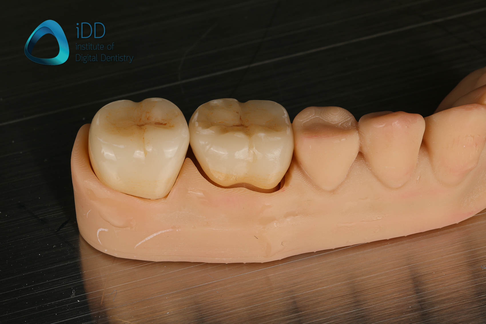 figure-9-e-max-crowns-post-processing-teeth Figure 9. IPS e.max crowns before and after post-processing including ceramic characterisation, glazing and firing.
