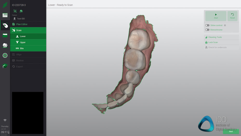 straumann virtuo vivo intraoral scanner review institute of digital dentistry (31)