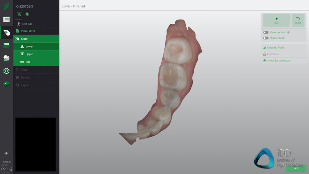 straumann virtuo vivo intraoral scanner review institute of digital dentistry (32)