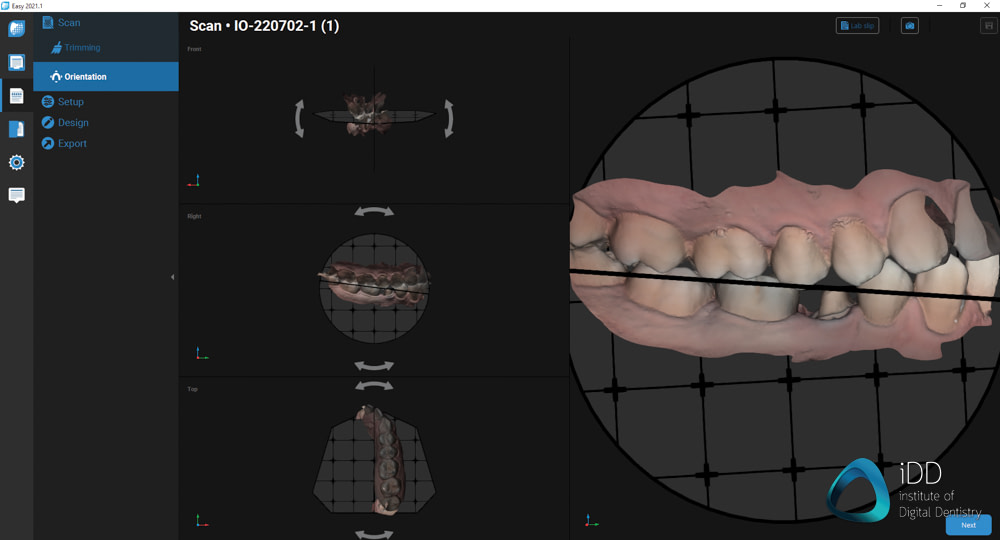 straumann virtuo vivo intraoral scanner review institute of digital dentistry (44)