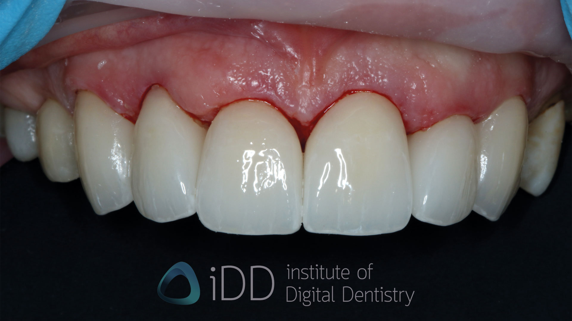 Fig-05-Olivia-after-how-to-transition-into-digital-dentistry-workflows-watermarked