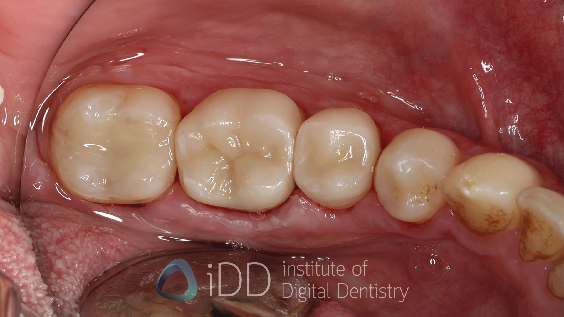 Fig-15-Matt-after-how-to-transition-into-digital-dentistry-workflows-watermarked