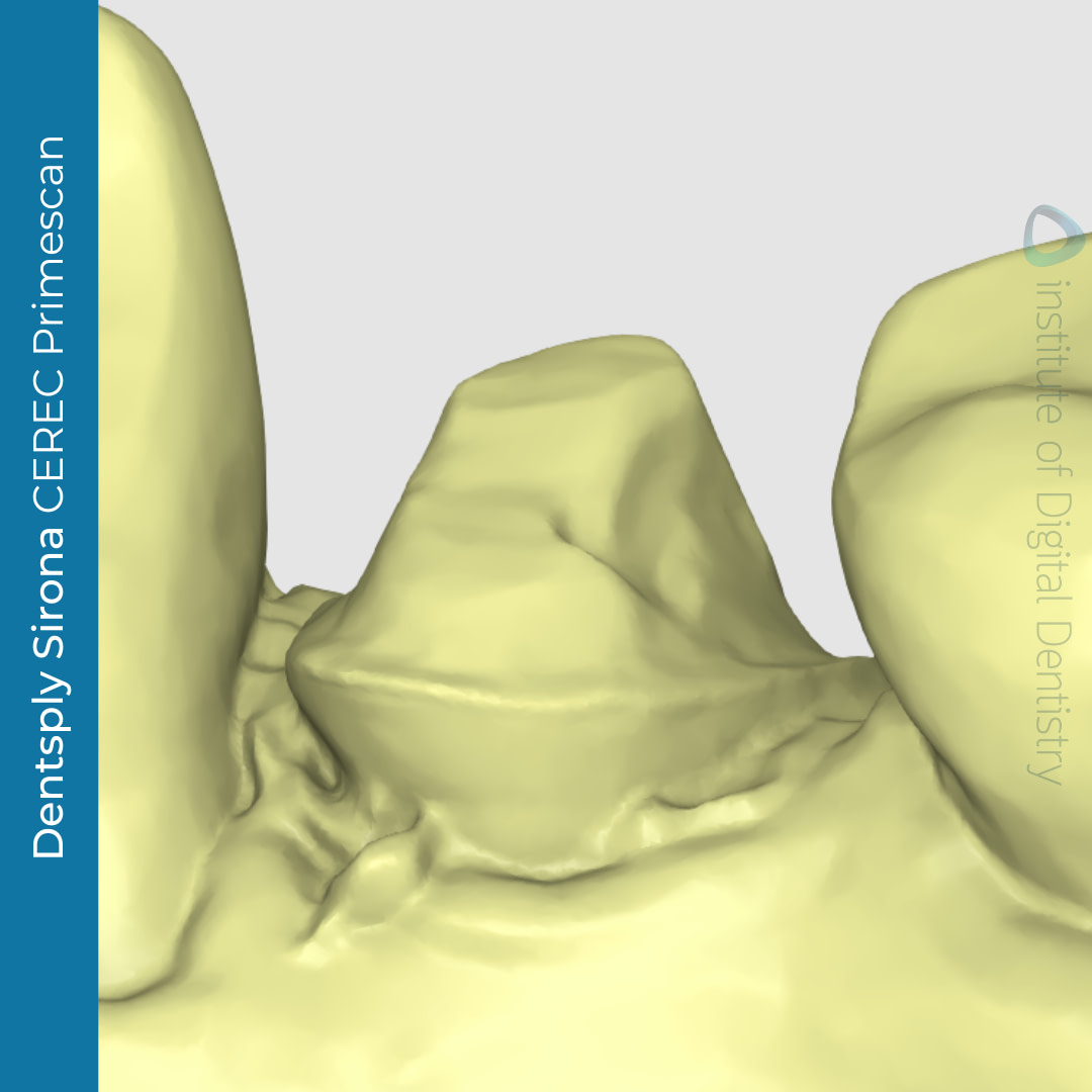 CEREC-primescan-margin-line