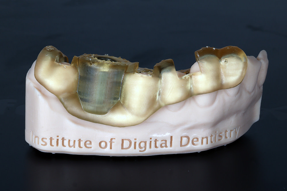 surgical guide 3d printed digital dentistry
