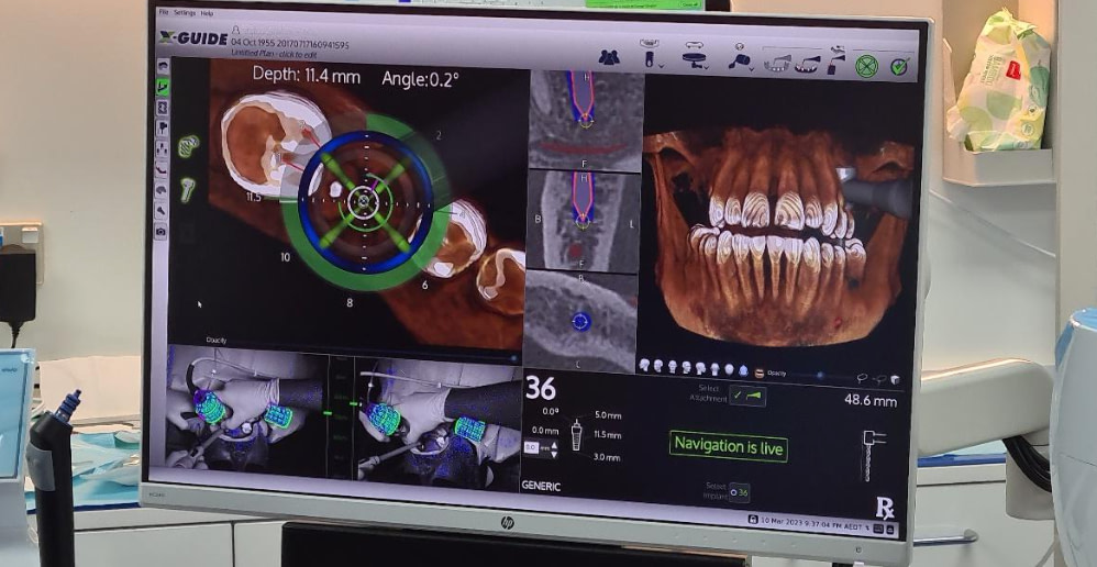 x-guide-implant-software