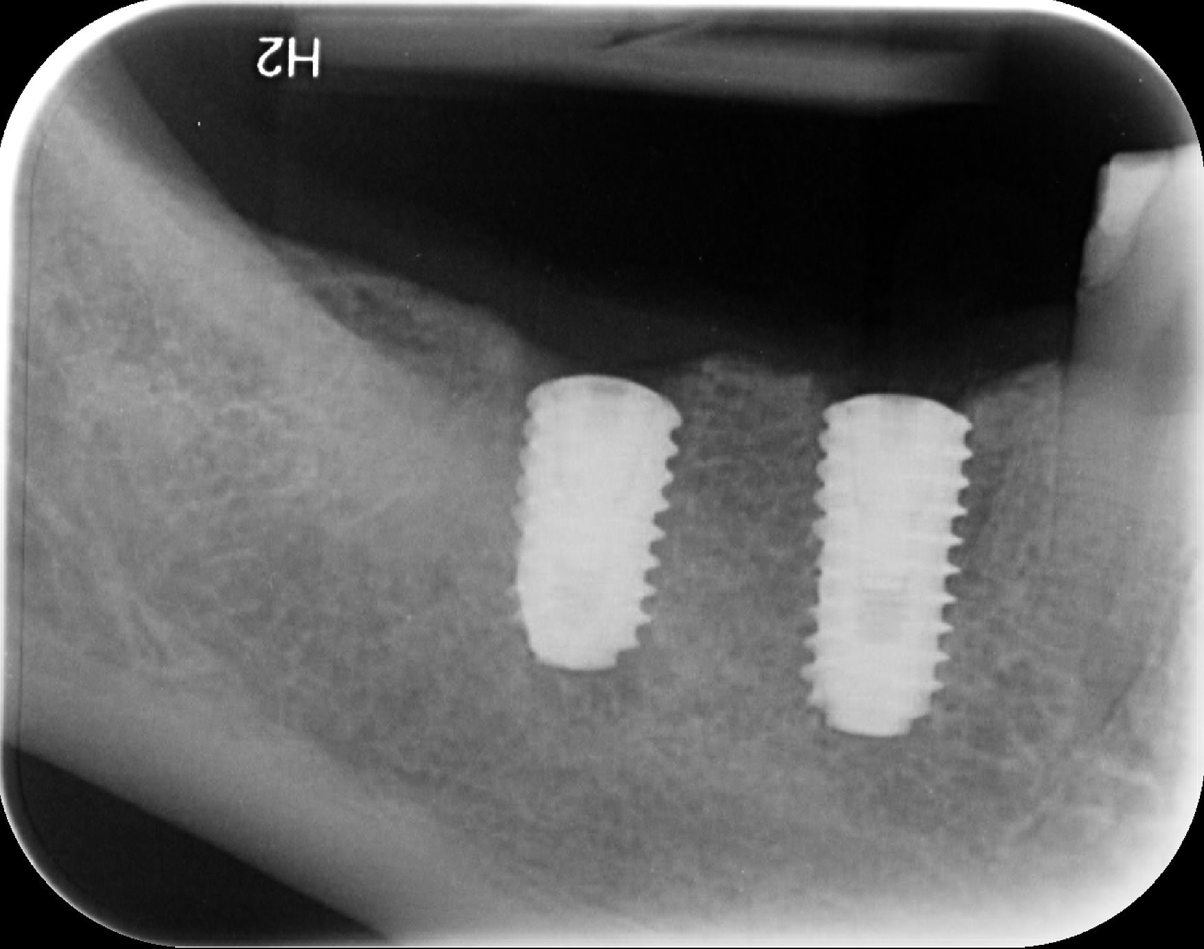 x guide surgery post op xray