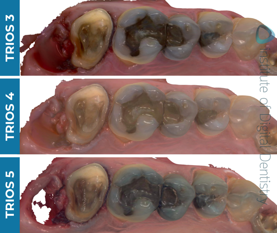 iDD-compares-color-scans-3shape-intraoral-scanner-trios3-trios4-trios5 iDD-compares-color-scans-3shape-intraoral-scanner-trios3-trios4-trios5