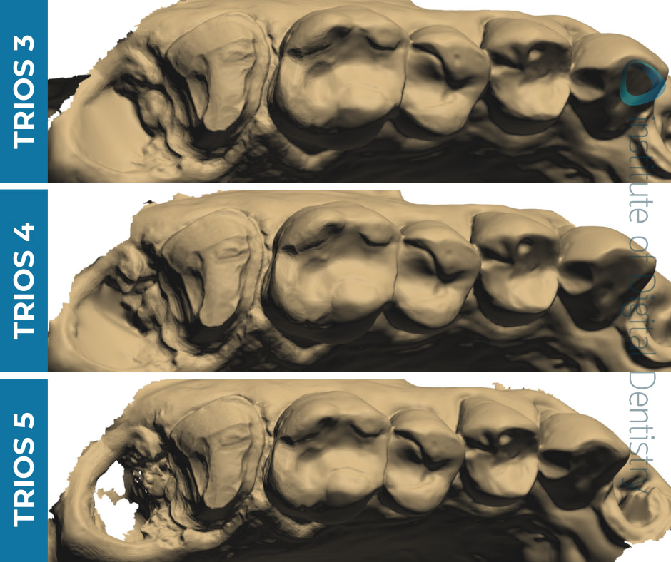 iDD-compares-monochrome-scans-3shape-intraoral-scanner-trios3-trios4-trios5 iDD-compares-monochrome-scans-3shape-intraoral-scanner-trios3-trios4-trios5