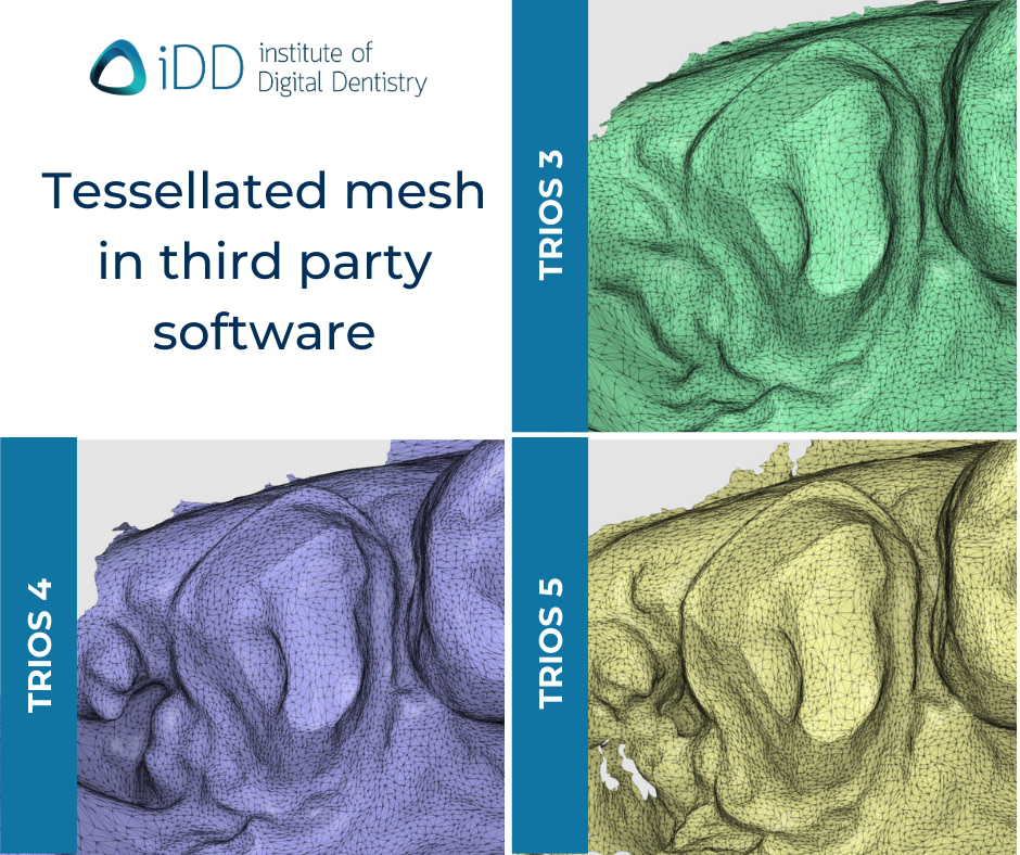 iDD-compares-tessellated-mesh-3shape-intraoral-scanner-trios3-trios4-trios5 Tessellated meshes of each TRIOS scan as previewed in the Medit Design app.