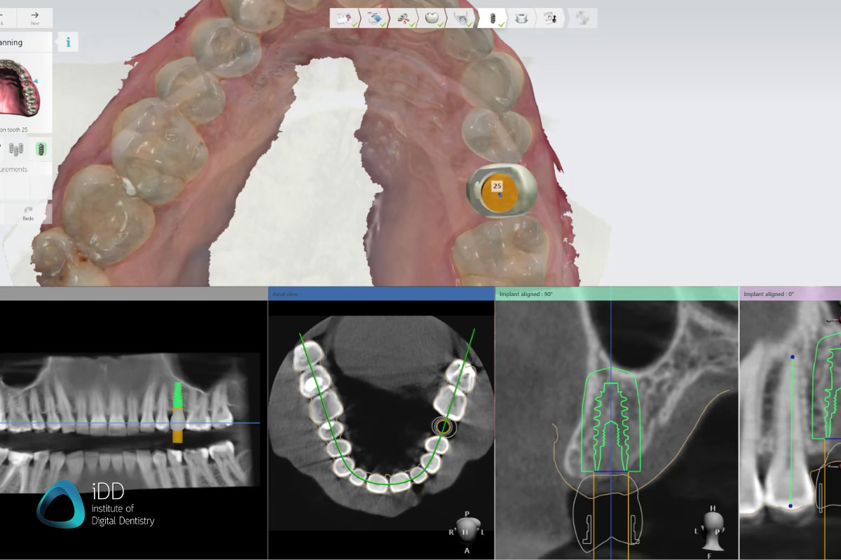 idd-3d-printed-surgical-guides-workflow-patient-intraoral-scans-cbct-3shape-implant-studio-digital-tooth-mockup