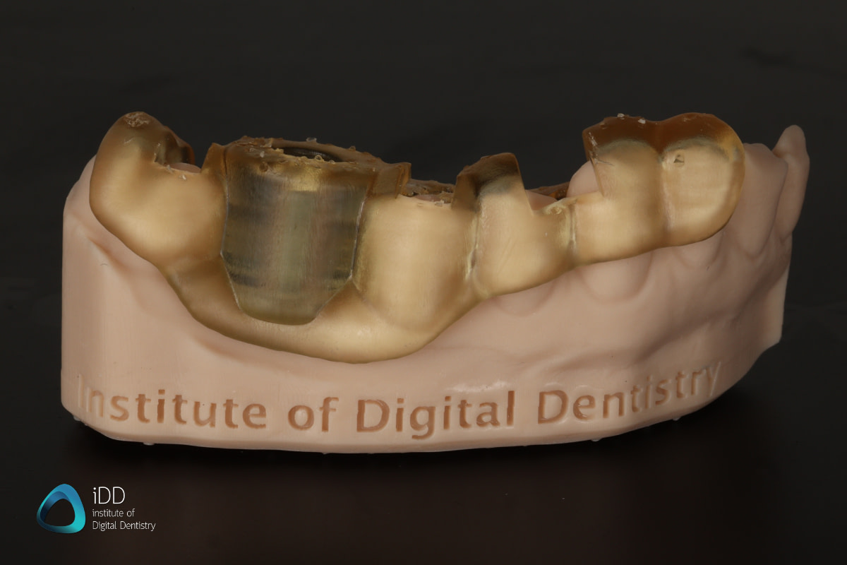idd-3d-printed-surgical-guides-workflow-example-with-metal-sleeve