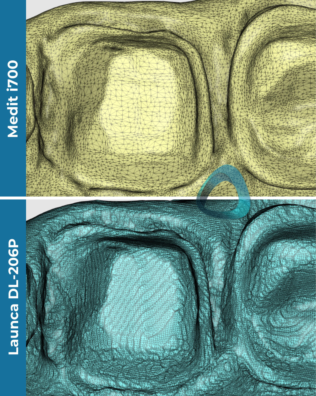 idd-compares-intraoral-scanners-medit-i700-launca-dl206p-tessellated-mesh
