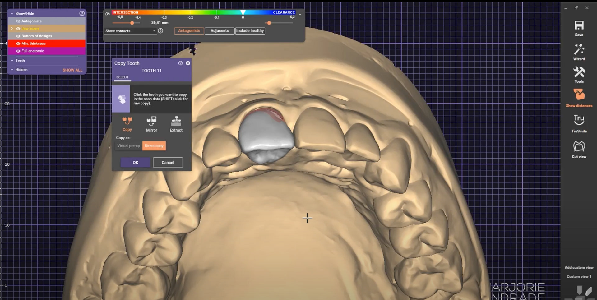 exocad-anterior-crown designing crowns and bridges in exocad DentalCAD
