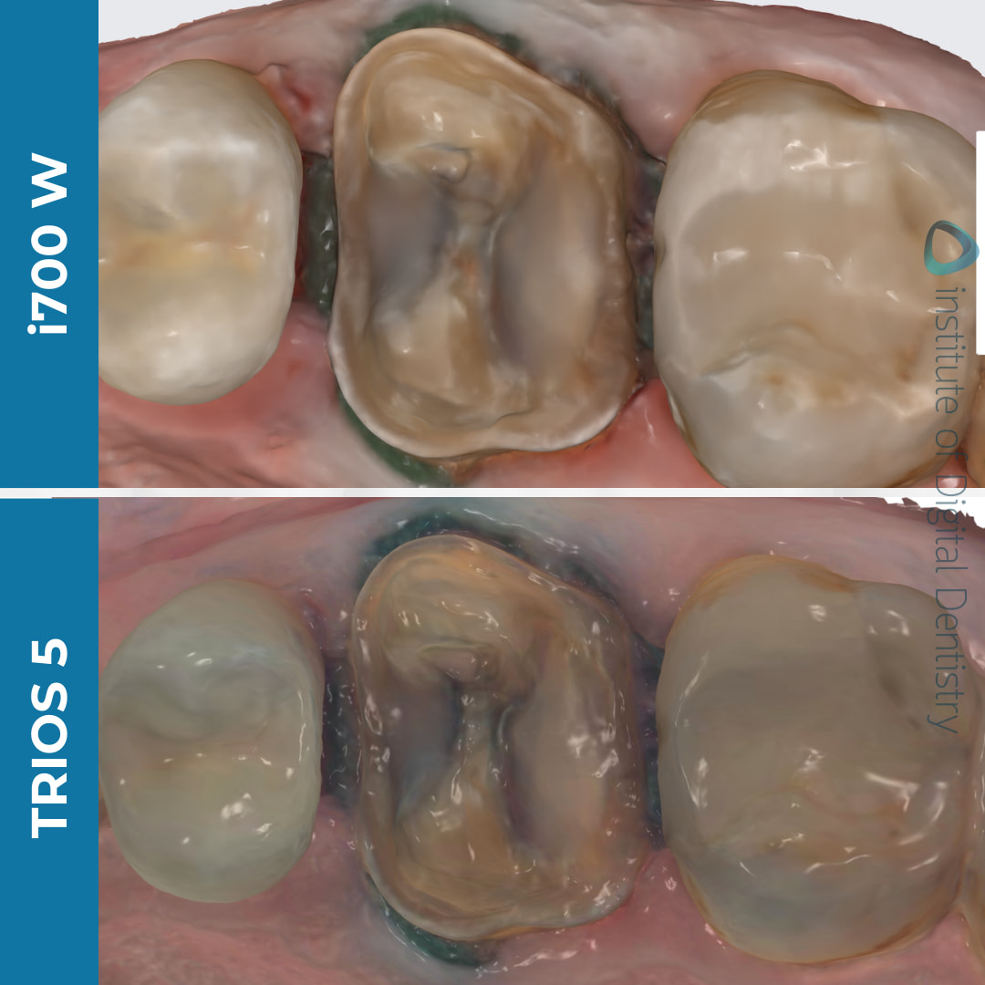 medit-i700w-3shape-trios5-intraoral-scanner-idd-compares-color-processed-scans