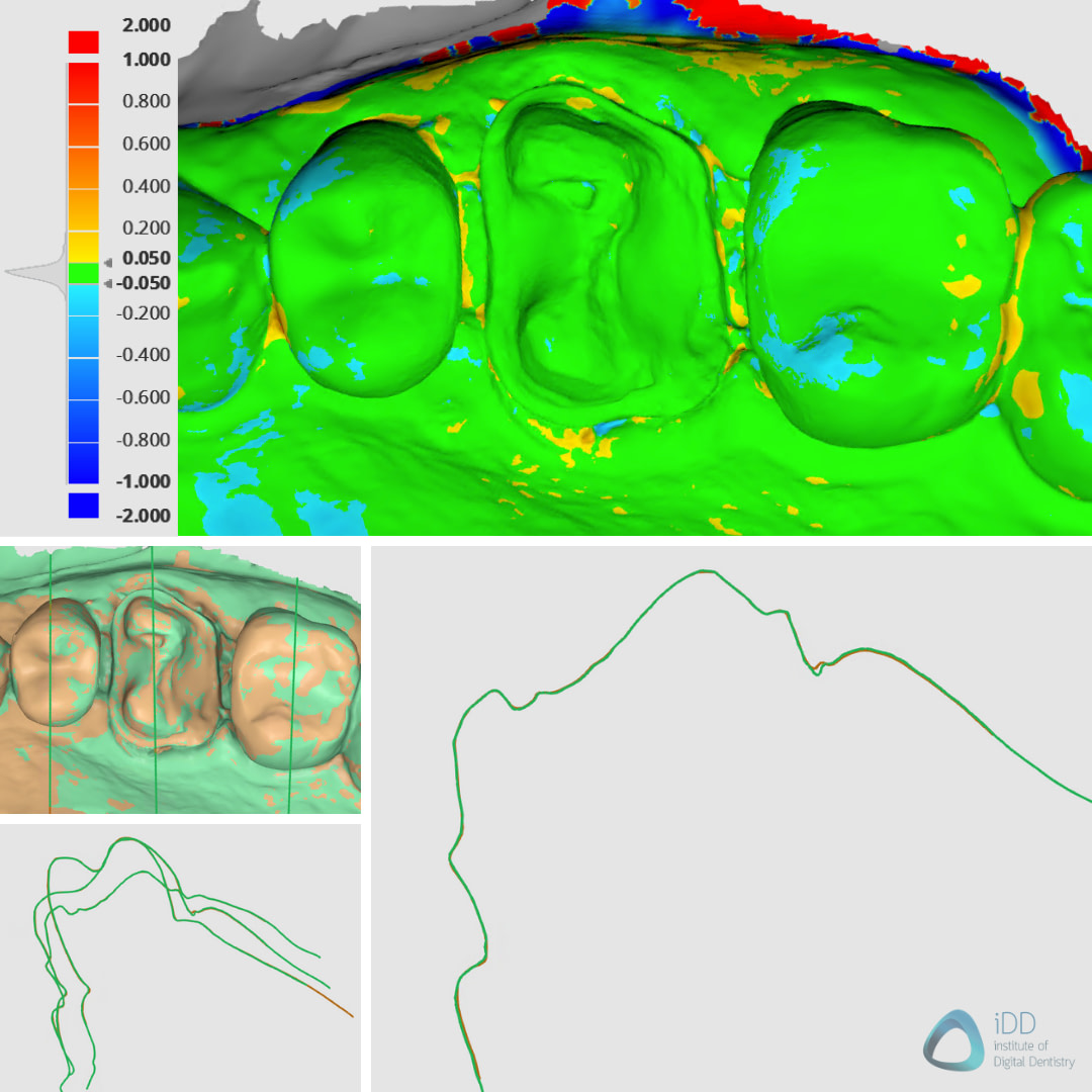 medit-i700w-3shape-trios5-intraoral-scanner-idd-compares-deviation-map-accuracy-sectional-view-scans
