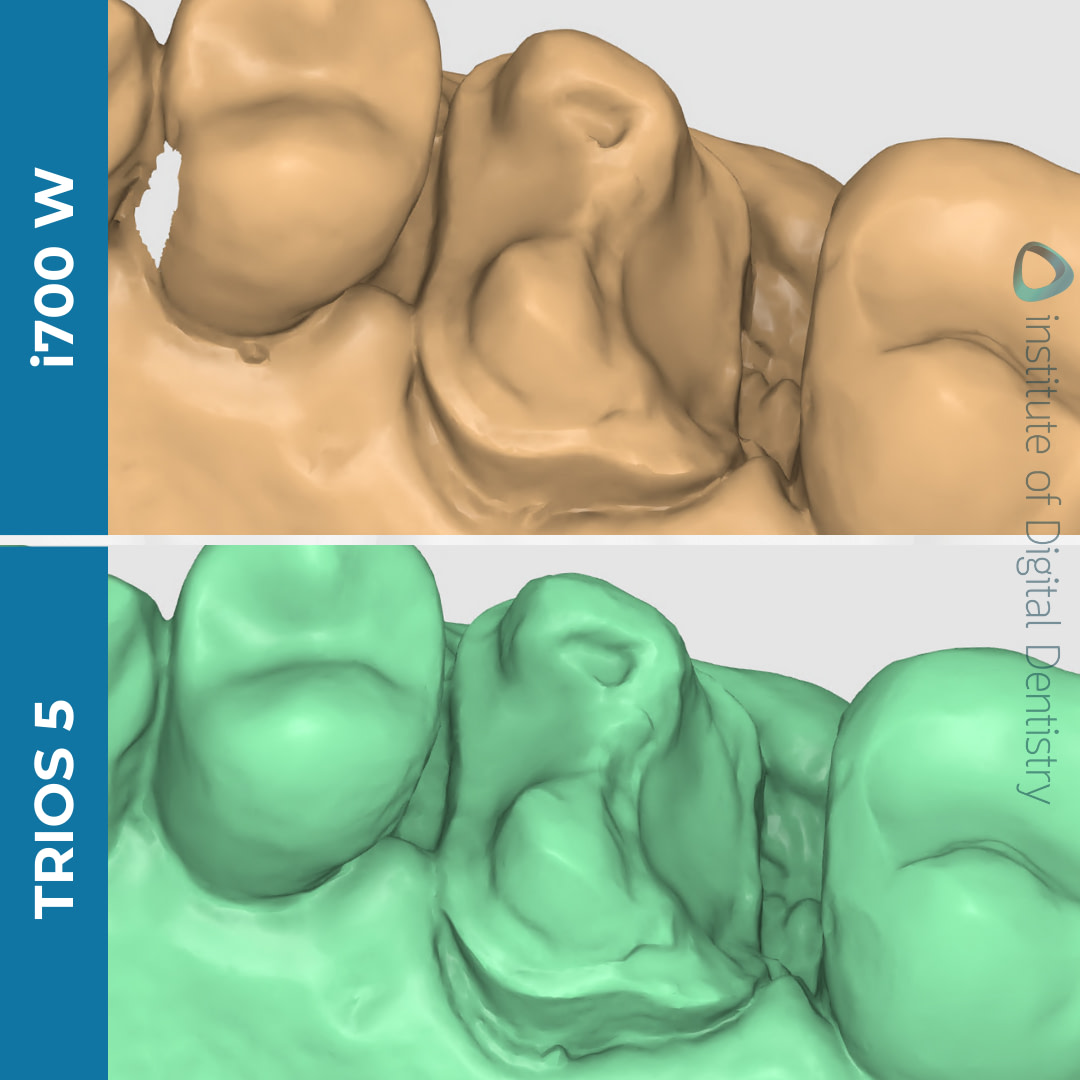 medit-i700w-3shape-trios5-intraoral-scanner-idd-compares-margin-prep-line-stl-scan