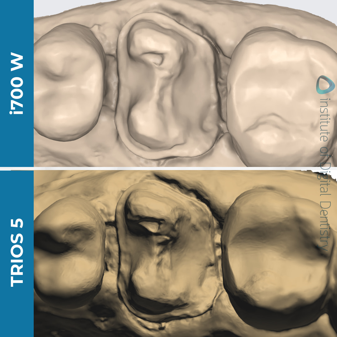 medit-i700w-3shape-trios5-intraoral-scanner-idd-compares-monochrome-processed-scans