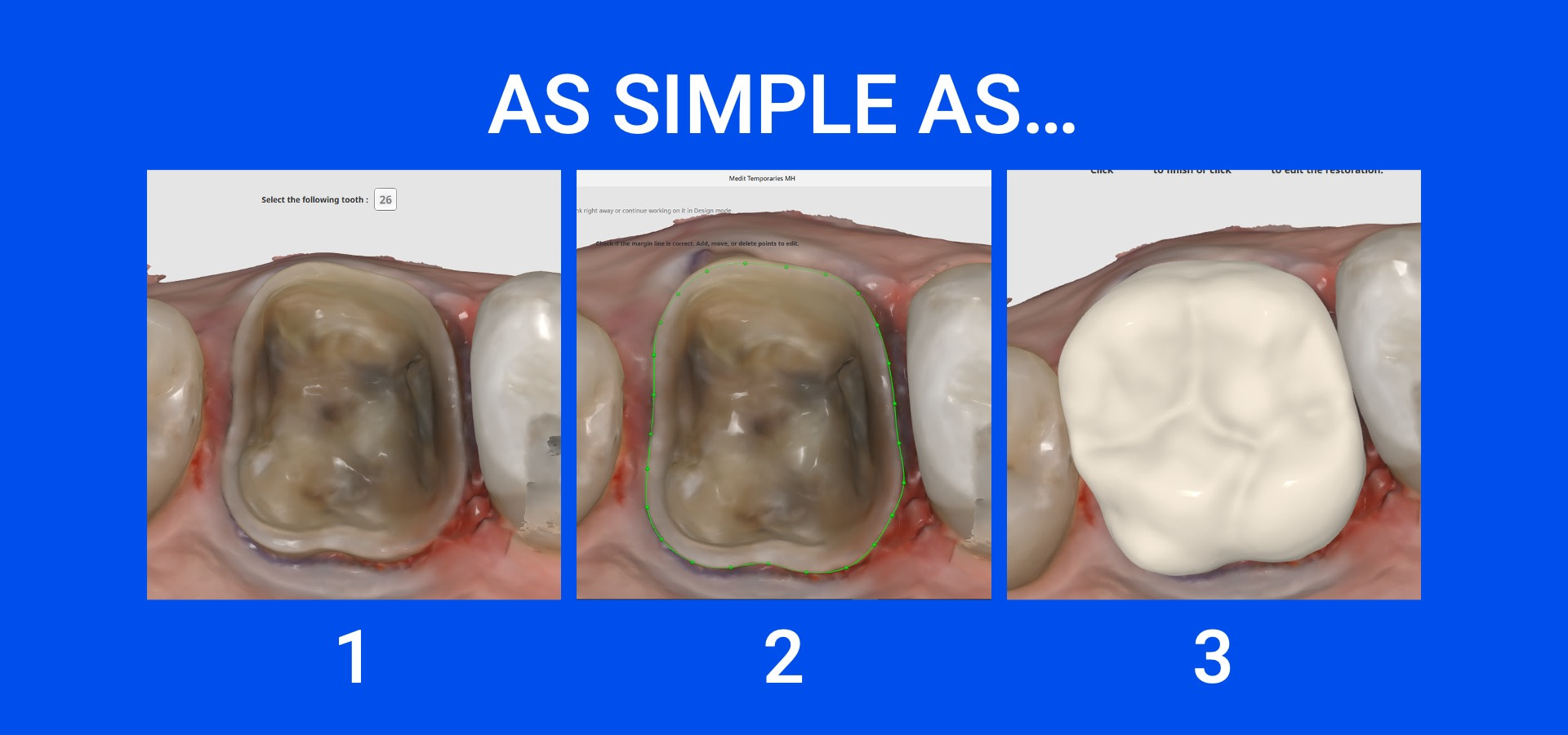 21 - Medit Innovation Day 2023 Presentation Single-Visit Restorations Using Medit ClinicCAD Ahmad Al-Hassiny - Slide21