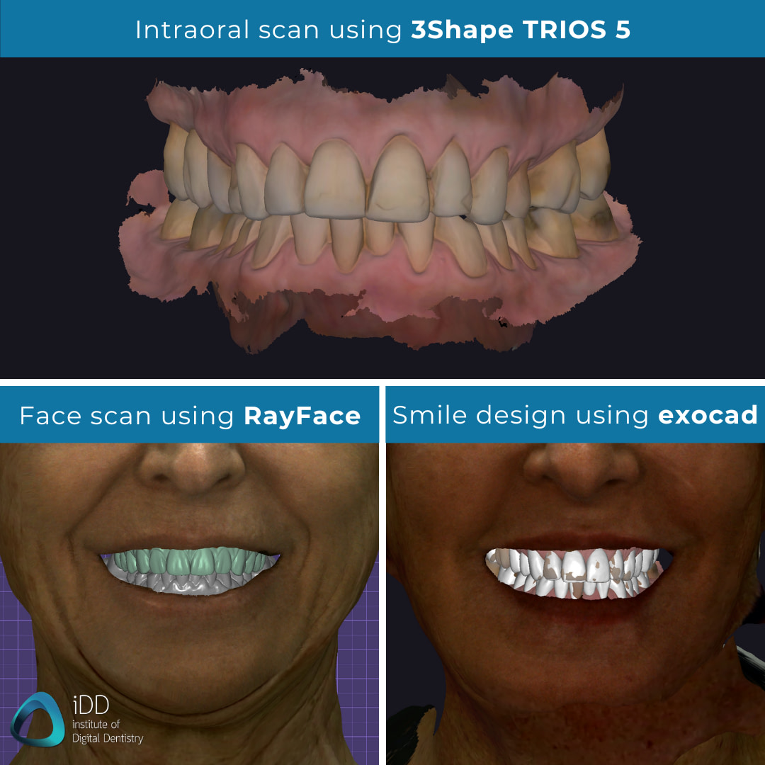 idd-clinical-case-digital-dental-full-mouth-rehabilitation-workflow-face-scan-rayface-smile-design-exocad-intraoral-scanner-3shape-trios-5