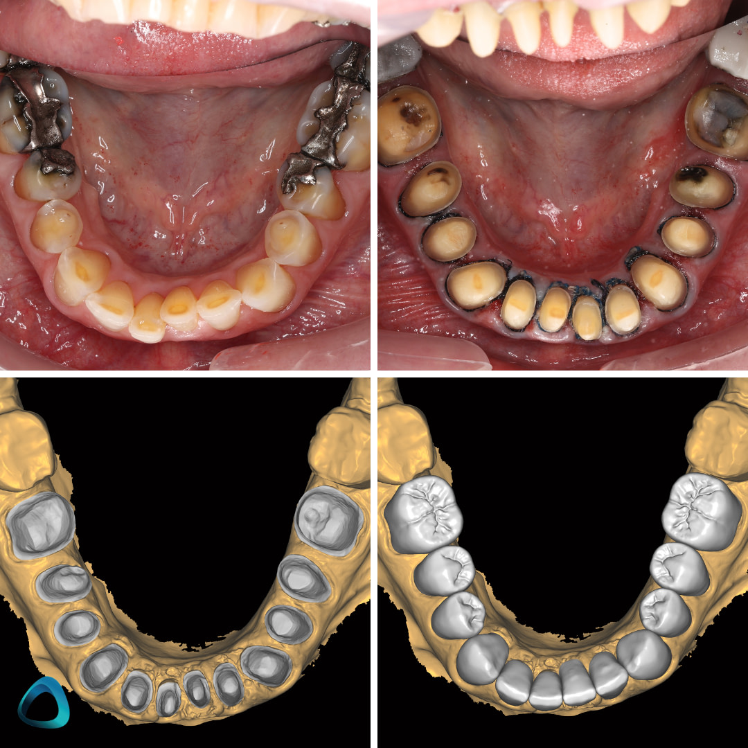 idd-clinical-case-digital-dental-full-mouth-rehabilitation-workflow-lower-mandibular-prep-scans