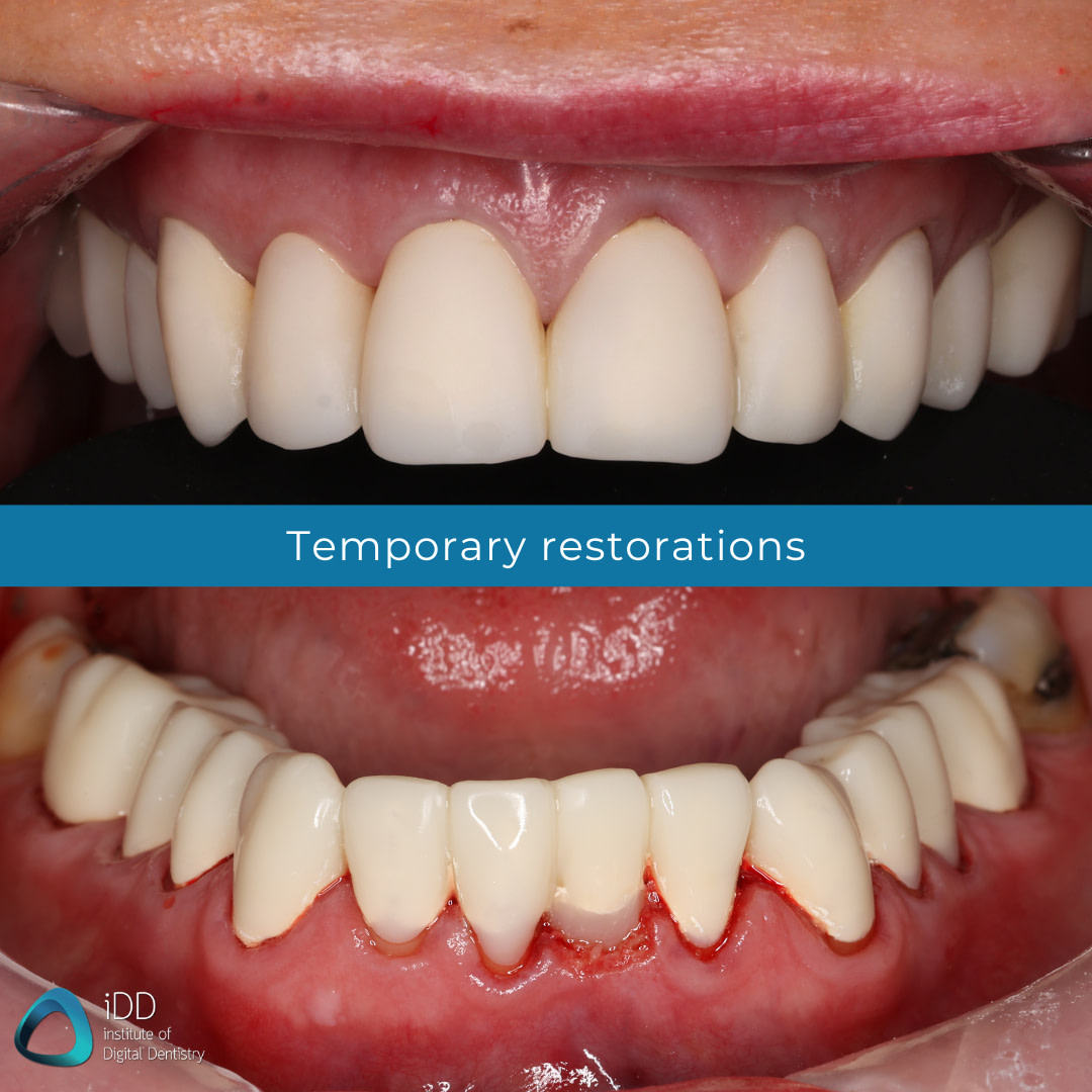 idd-clinical-case-digital-dental-full-mouth-rehabilitation-workflow-lower-upper-try-in-temporary-restorations