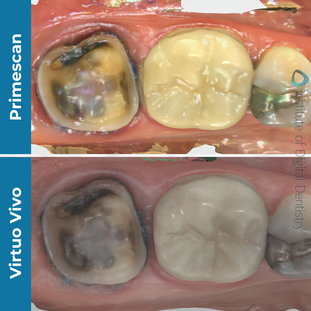 idd-compares-dentsply-sirona-cerec-primescan-straumann-virtuo-vivo-intraoral-scanner-color-native-processed-scans