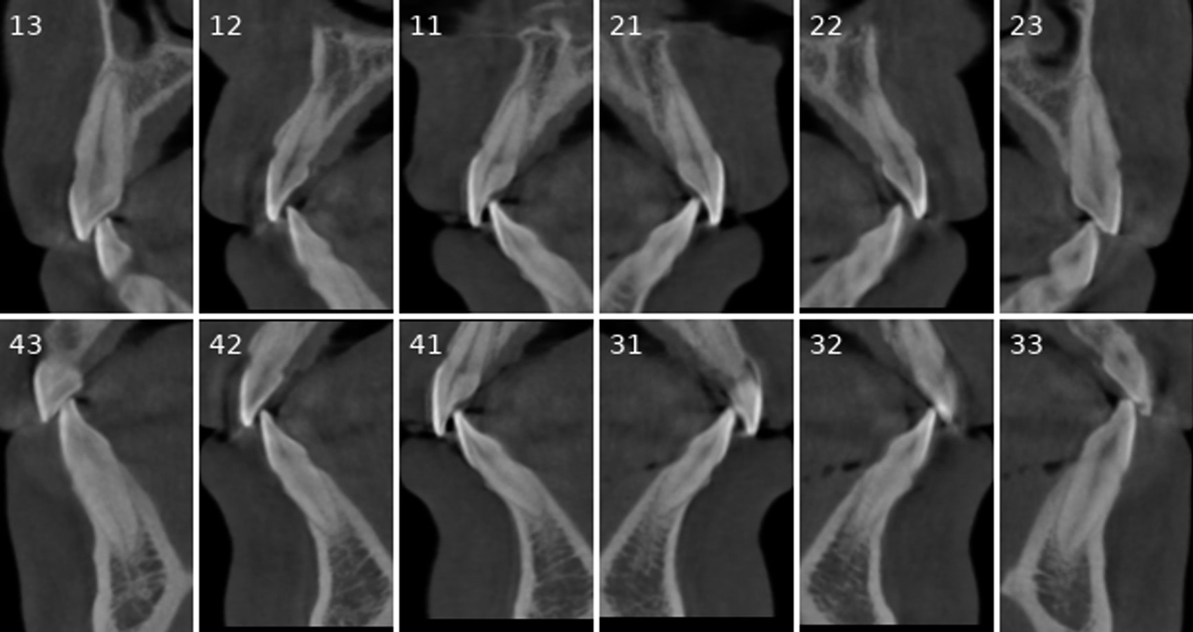 Anterior Teeth Cross Section