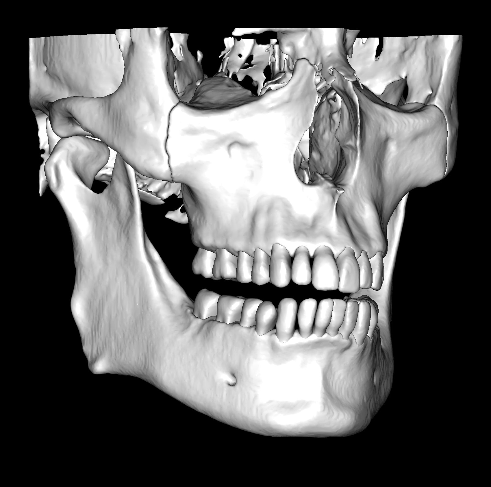 CBCT STL 1