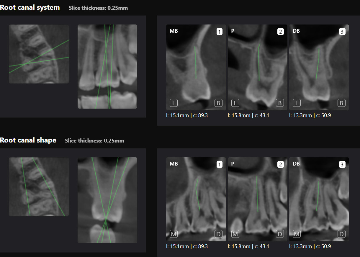Root canal shapes
