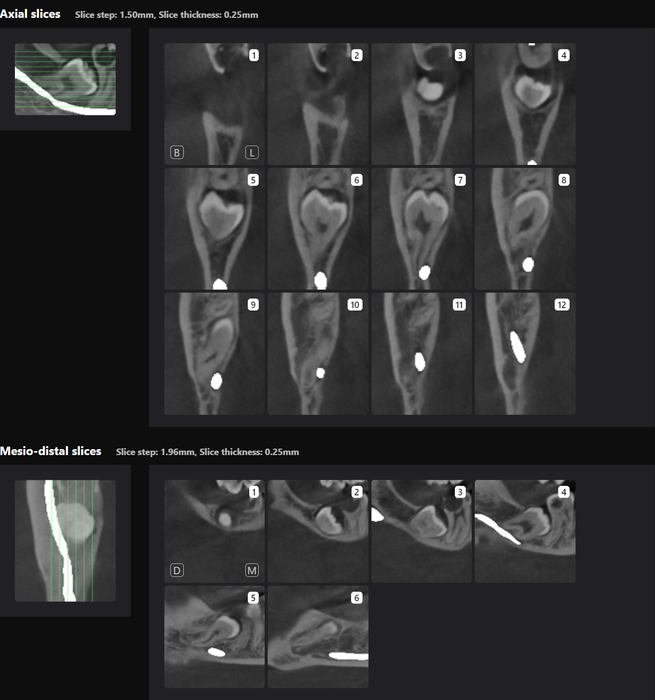 Third Molar Slices 2