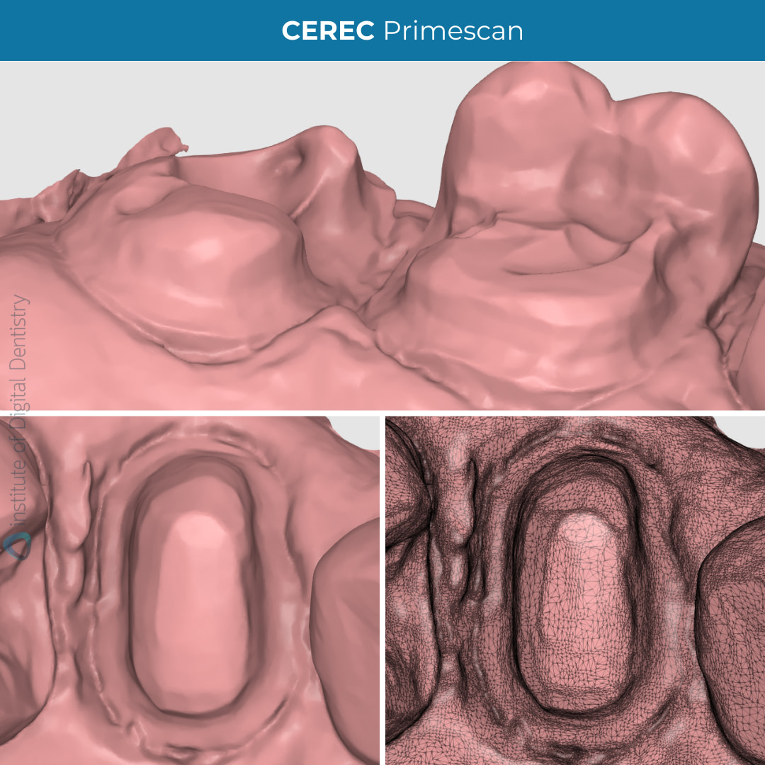 idd-compares-dentsply-sirona-cerec-primescan-intraoral-scanner-scan-margin-prep-tessellated-mesh-zoom-scans