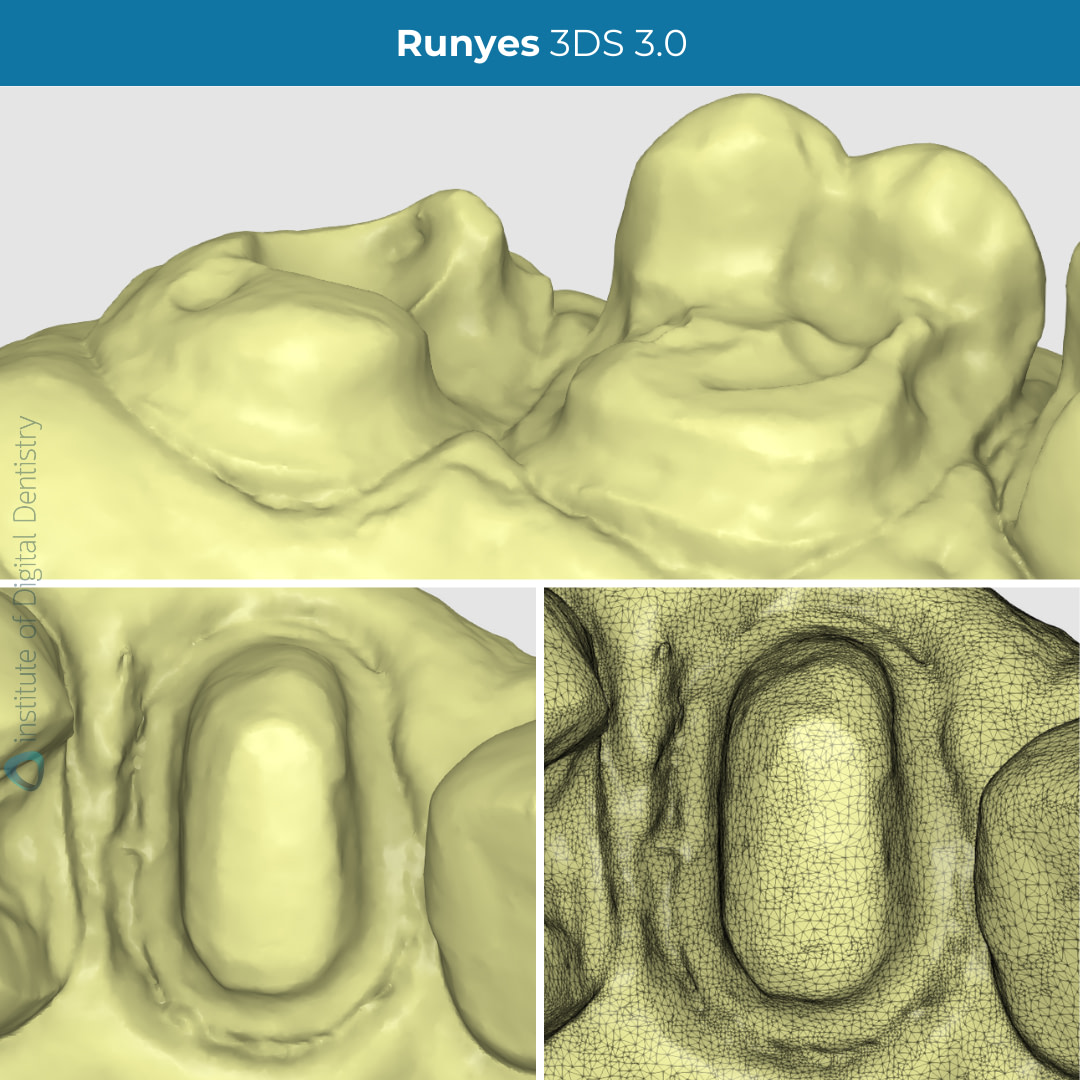 idd-compares-runyes-3ds-3.0-intraoral-scanner-scan-margin-prep-tessellated-mesh-zoom-scans