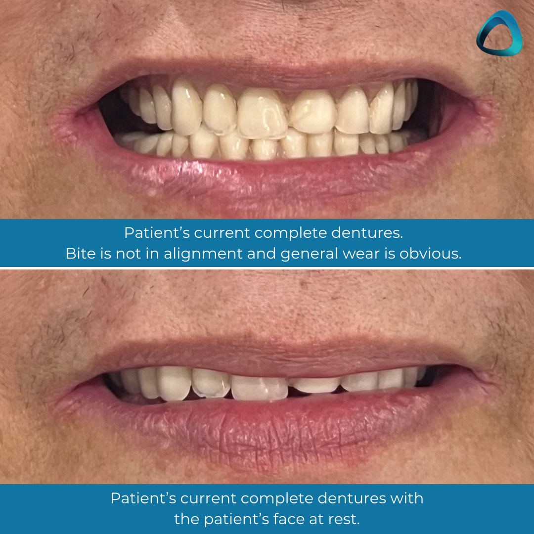 idd-digital-dentures-blog-clinical-case-patient-before-complete-dentures