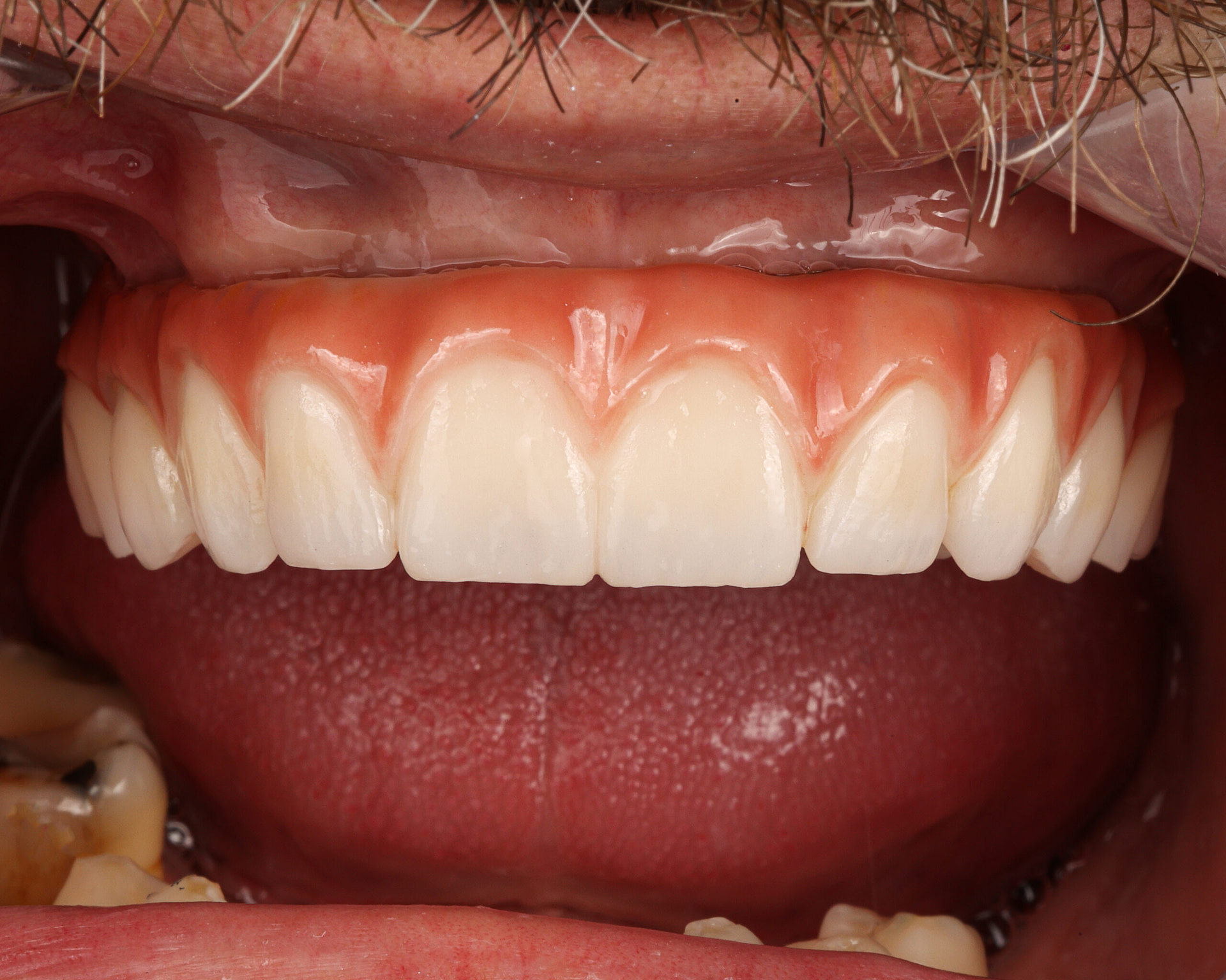 All-on-x after All-on-X Implants