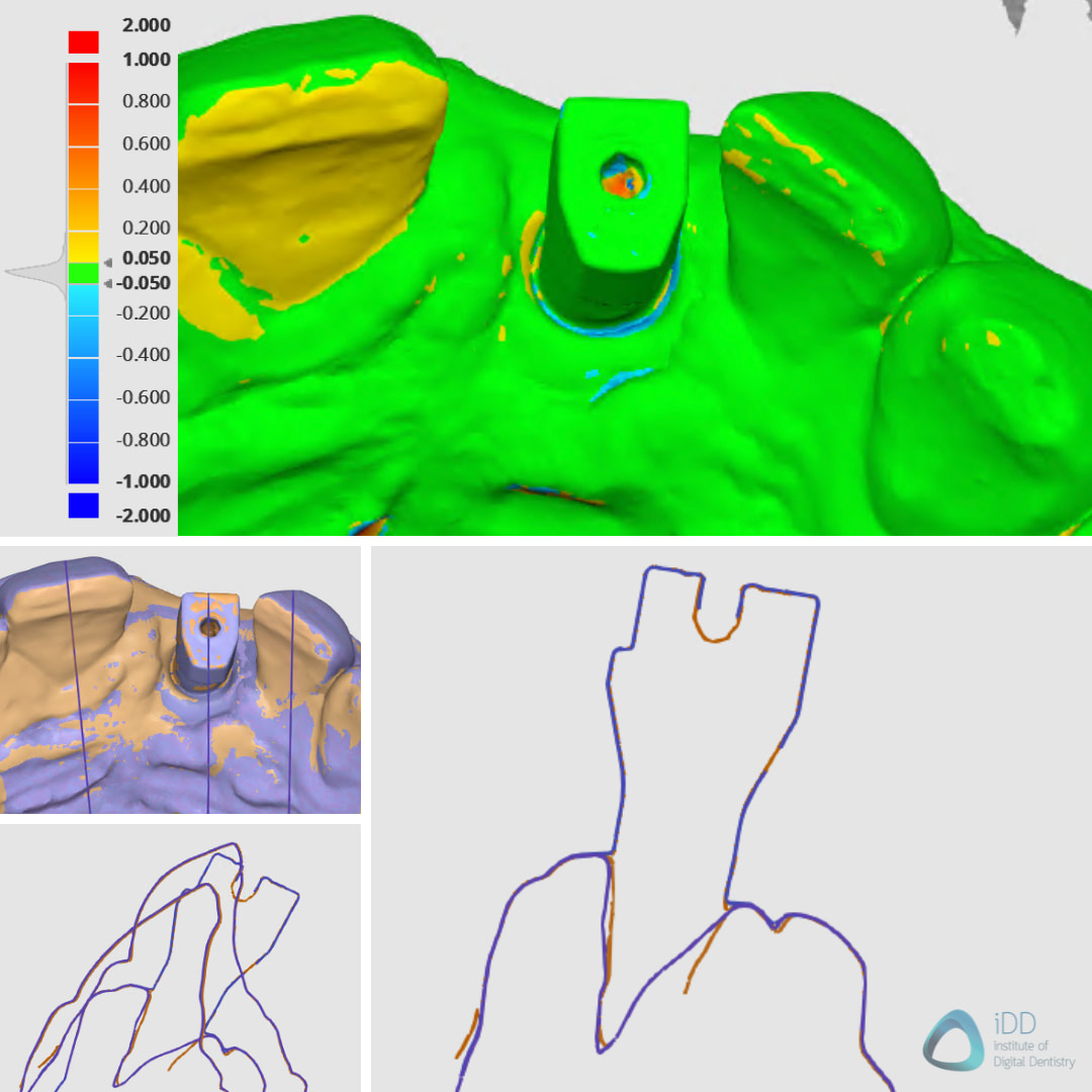 idd-compares-medit-i700w-runyes-3ds-3.0-intraoral-scanner-scan-body-implant-deviation-map-accuracy-sectional-scans
