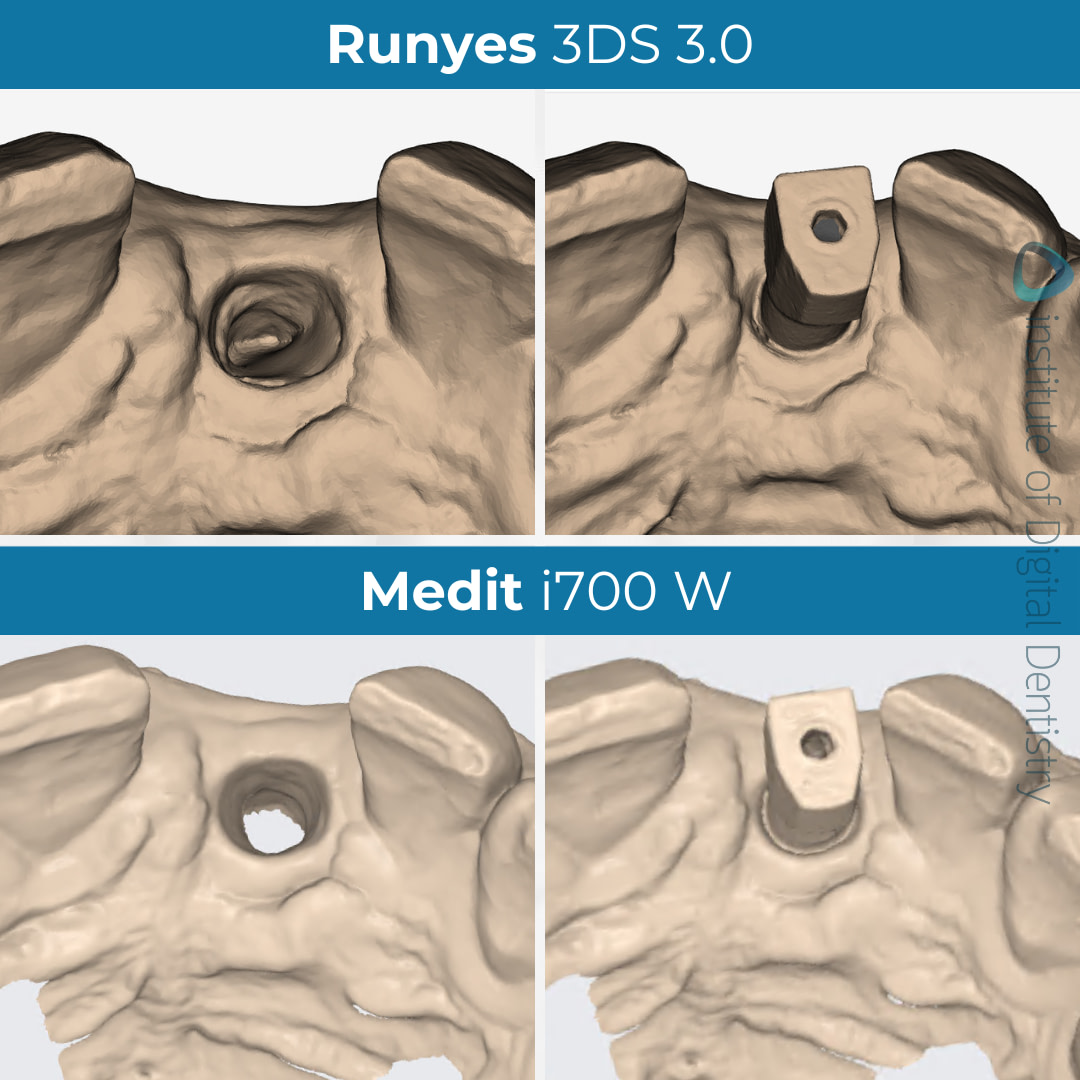 idd-compares-medit-i700w-runyes-3ds-3.0-intraoral-scanner-scan-body-implant-monchrome-processed-native-scans