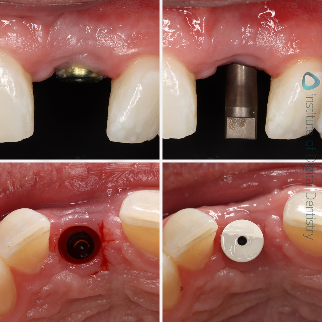 idd-compares-medit-i700w-runyes-3ds-3.0-intraoral-scanner-scan-body-implant-photos