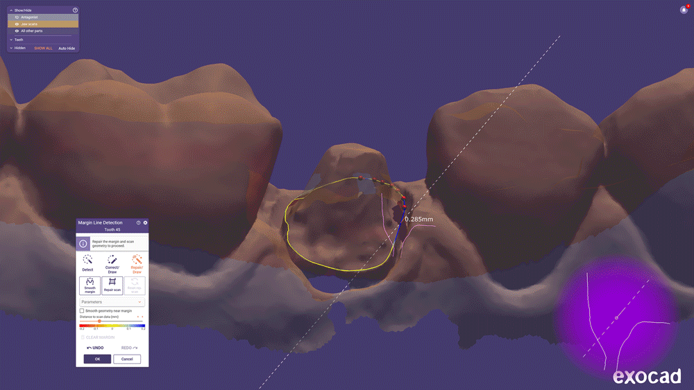 exocad_DentalCAD_Elefsina_Features_1