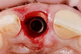 Partial Extraction Therapy (PET)2