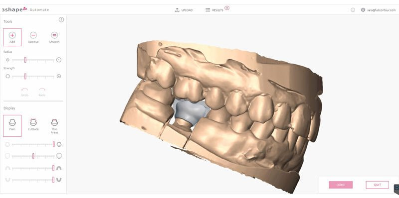 3shape-trios-5-intraoral-scanner-review-automate-coping-pfm-crown-cad-design-idd-digital-dentistry