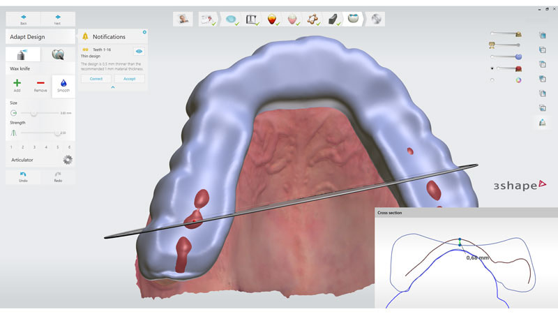 3shape-trios-5-intraoral-scanner-review-splint-nightguard-automate-software-cad-design-idd-digital-dentistry