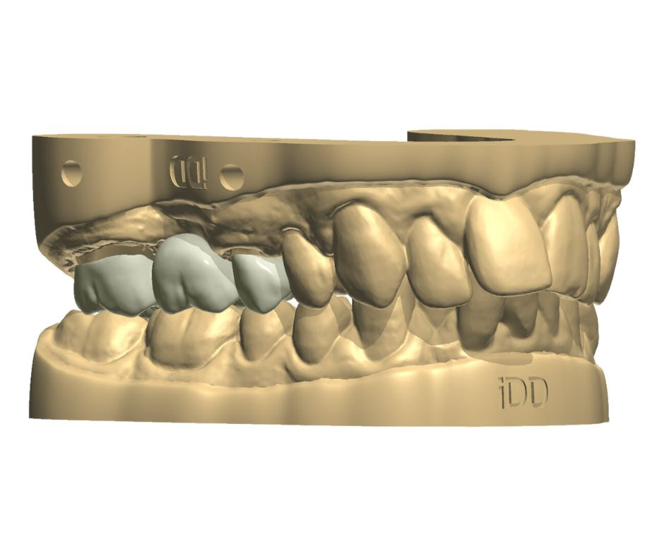 Crowns, bridges, and veneers