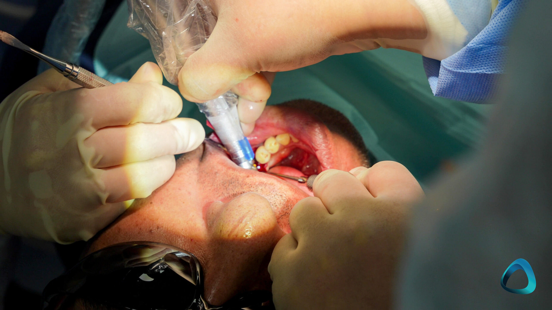 Live Patient Implant Surgery Wellington Institute of Digital Dentistry-8