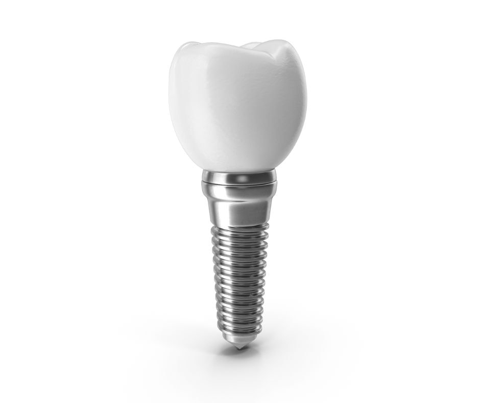 Single tooth implants