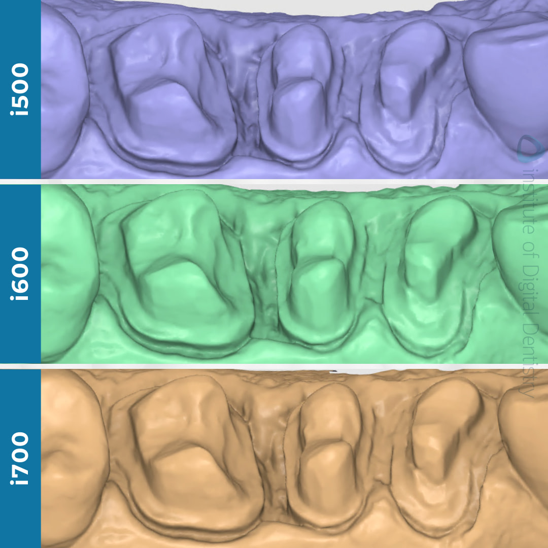 idd-compares-intraoral-scanner-medit-i500-i600-i700-margin-prep-line-buccal