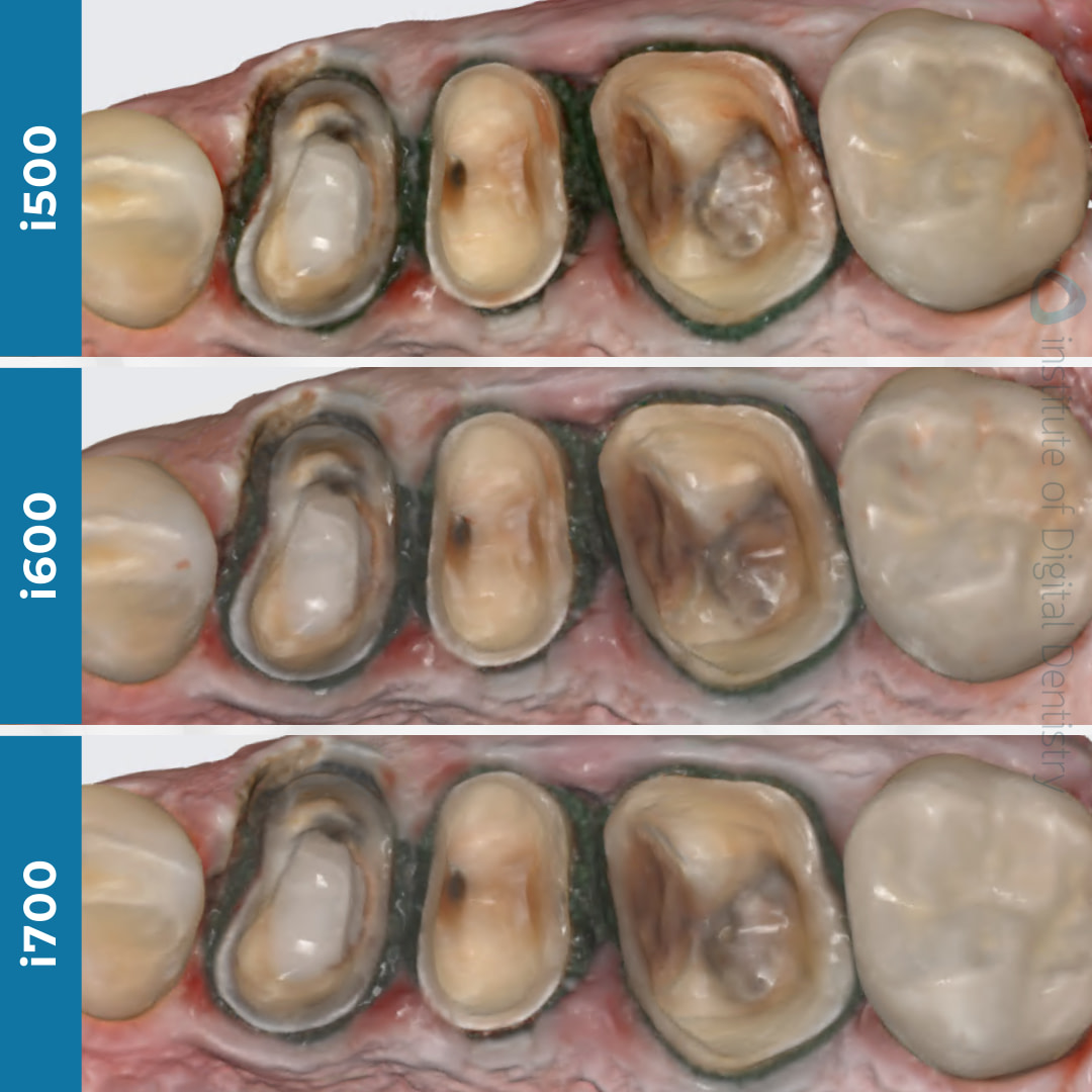 idd-compares-intraoral-scanner-medit-i500-i600-i700-native-processed-color-scans