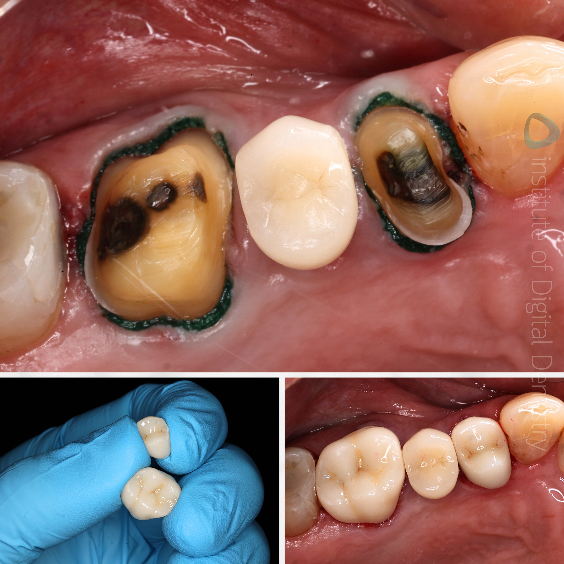 medit-intraoral-scanner-i500-i600-i700-wireless-i900-idd-compares-institute-of-digital-dentistry-blog-photo-prep-restoration-crown